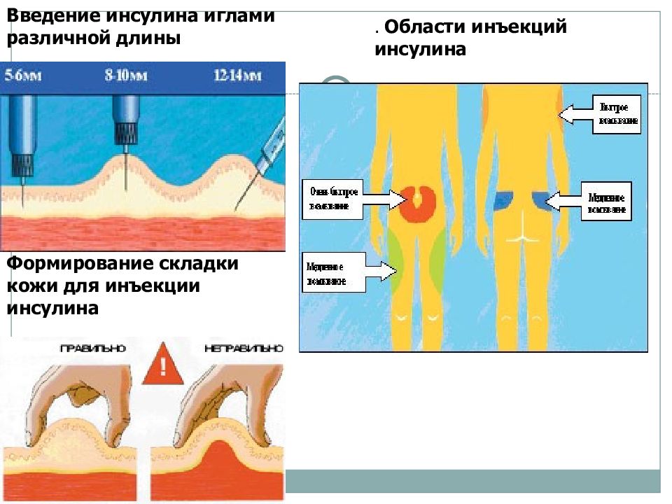 Схема введения инсулина