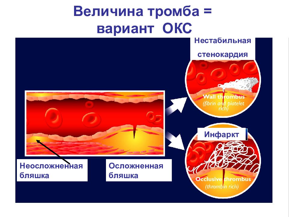 Окс нестабильная стенокардия