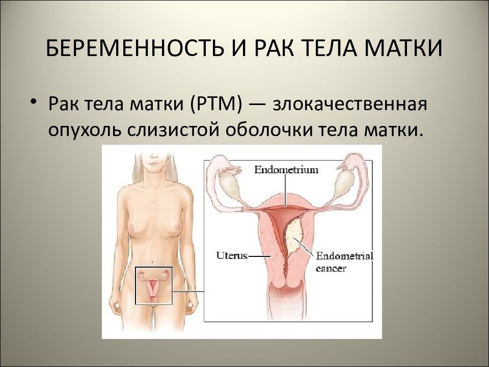 Профилактика рака тела матки презентация