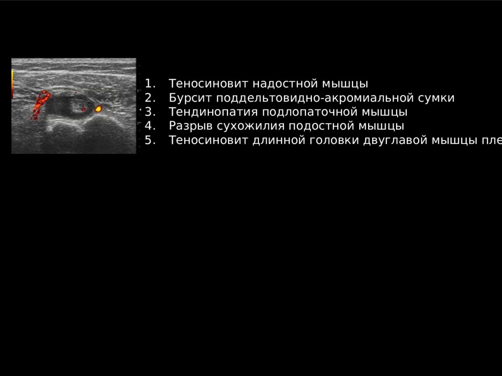 Теносиновит плечевого сустава. Теносиновит сухожилия надостной мышцы. Теносиновит надостной мышцы плечевого сустава на УЗИ. Тендинопатия сухожилия длинной головки бицепса УЗИ протокол. Теносиновит длинной головки двуглавой мышцы.