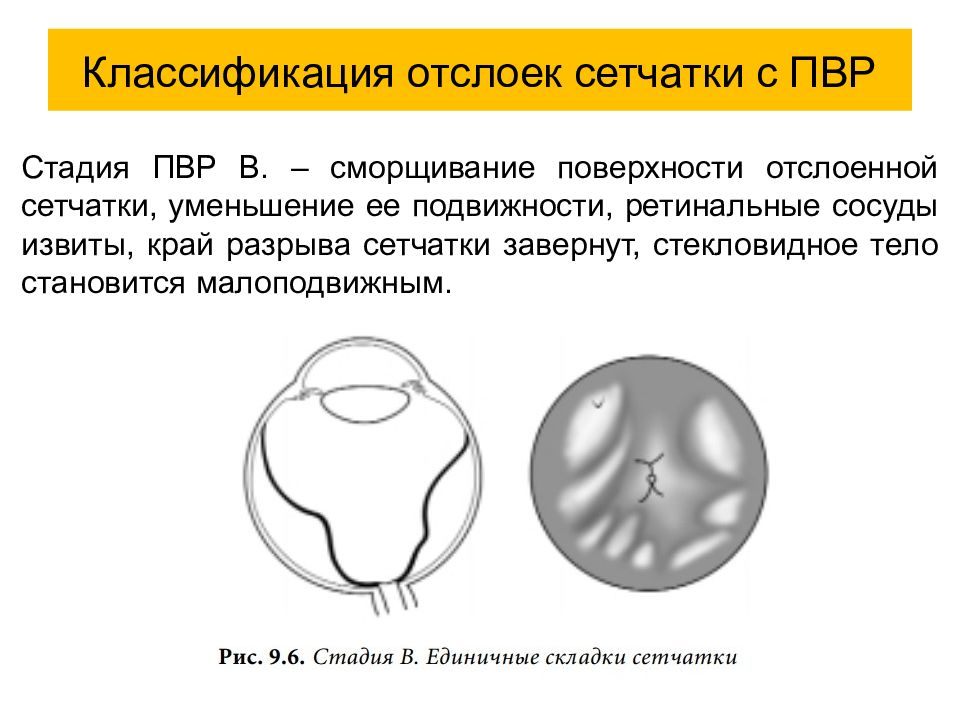 Презентация на тему отслойка сетчатки