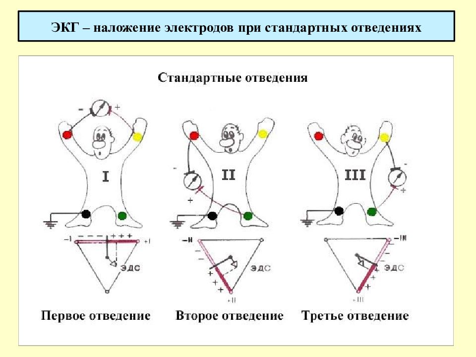 Схема экг как наложить