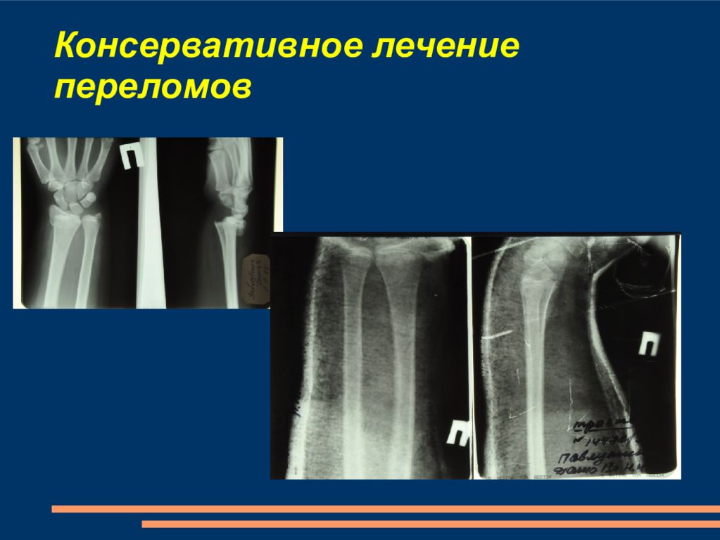 Переломы кисти травматология презентация