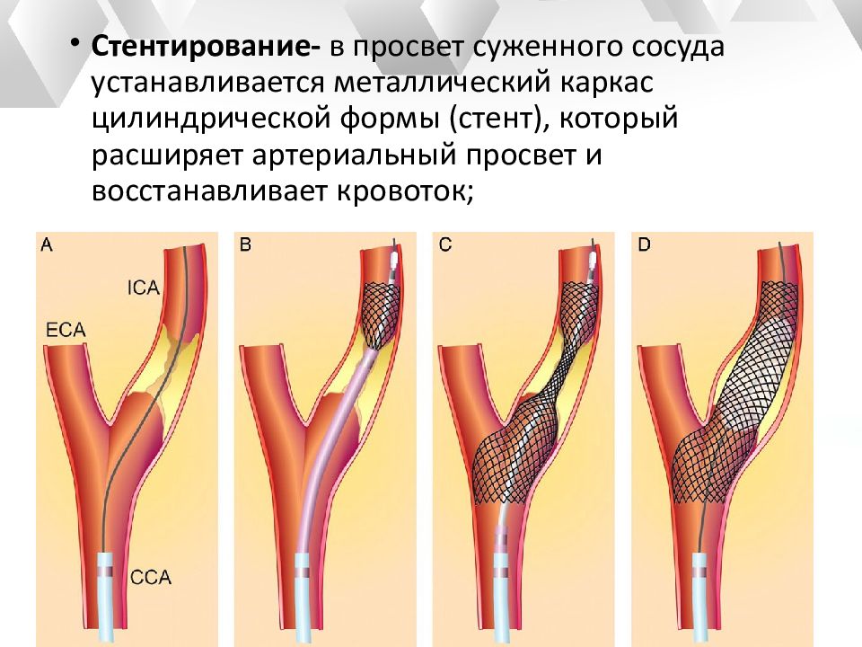 Стентирование это