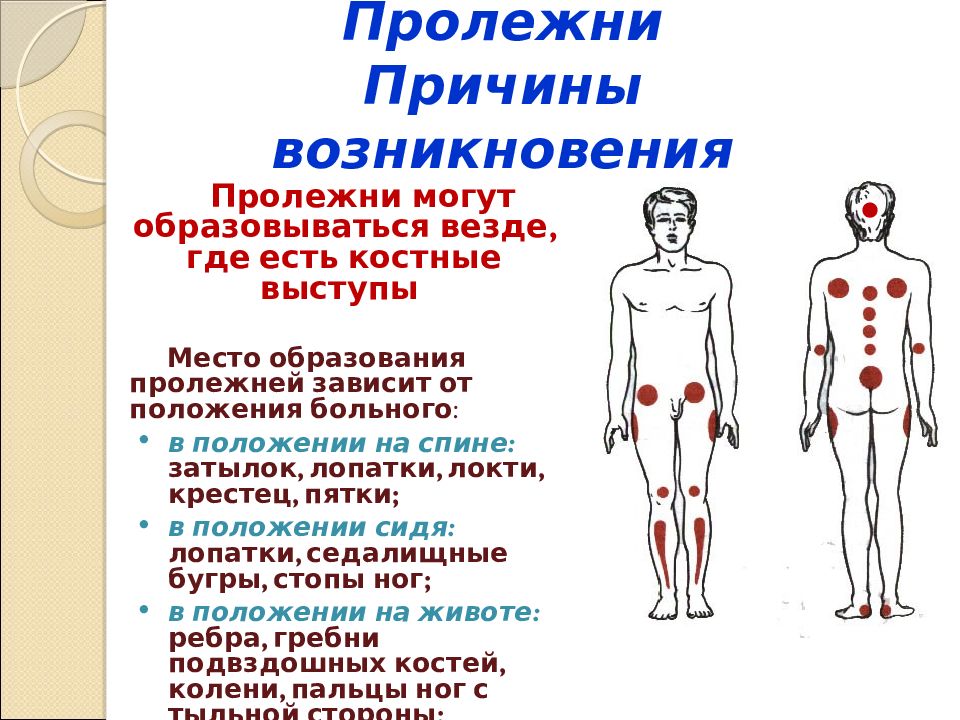 Места образования пролежней. Места образования пролежней у пациента. Места образования пролежней в положении сидя. Классификация пролежней.