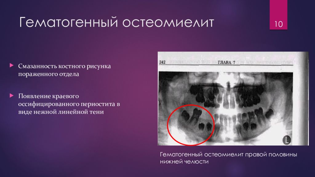 Гематогенный остеомиелит