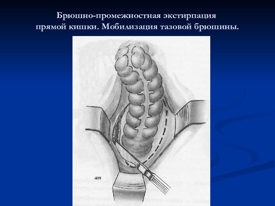 Экстирпация. Брюшно-промежностная экстирпация (операция Кеню-Майлса). Брюшнопромежностная экстирпация прямой кишки. Брюшно промежностная экстирпация прямой. Брюшно-промежностная экстирпация прямой кишки по Кеню Майлсу.