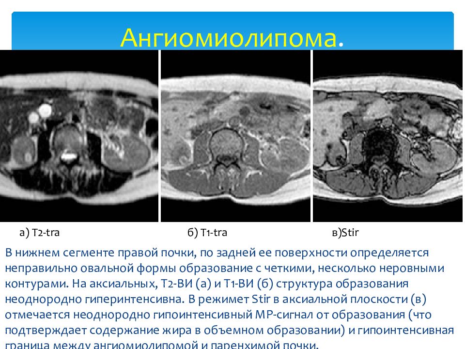 Ангиомиолипома левой почки что это. Ангиомиолипома почки кт. Ангиомиолипома на кт с контрастом.