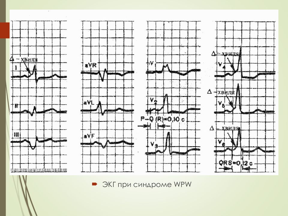 Экг синдромы. Блокада левой ножки пучка Гиса ЭКГ синдром wpw. Блокада пучка Гиса ВПВ. ЭКГ после РЧА при wpw синдроме. Блокада левой ножки пучка Гиса и синдром wpw.