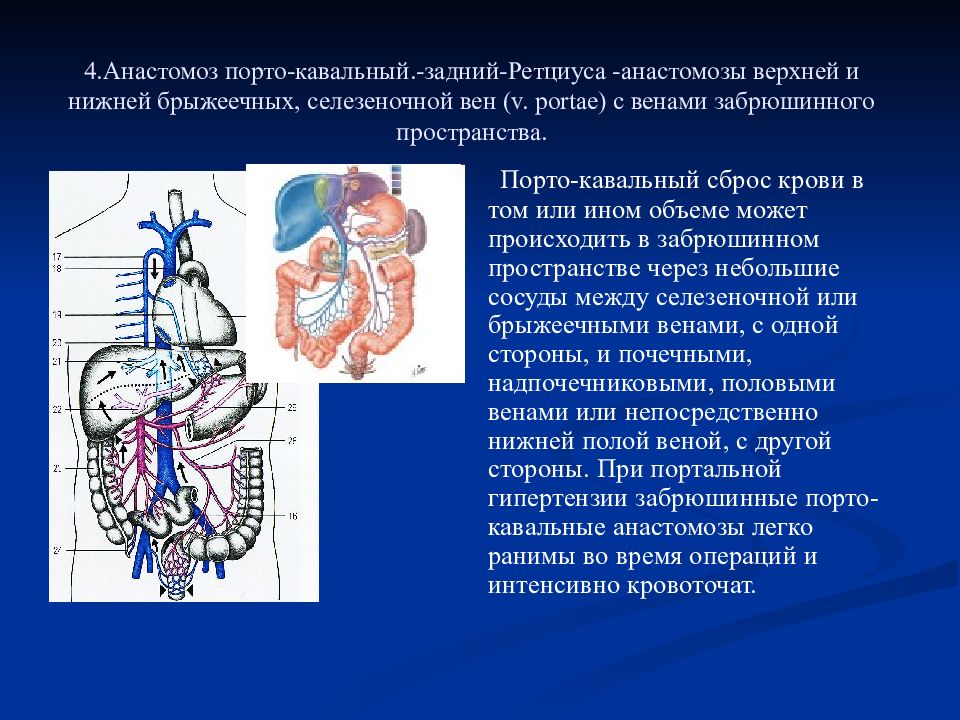 Порто кава кавальный. Анастомоз Ретциуса. Воротная Вена анастомозы. Порто-кавальный анастомоз. Каво кавальные анастомозы.