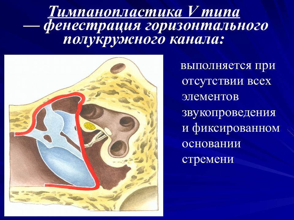 Операция на среднем ухе