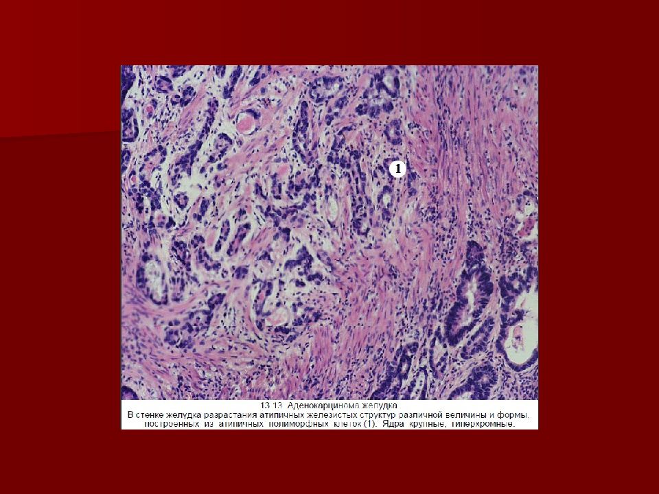 Аденокарцинома что это. Аденокарцинома кишечника микропрепарат. Аденокарцинома прямой кишки микропрепарат. Аденокарцинома Толстого кишечника микропрепарат. Аденокарцинома желудка препарат.