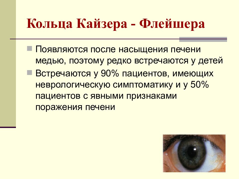 Болезнь вильсона. Вильсона Коновалова кольца Кайзера Флейшера. Кольца Кайзера -Флейшера болезнь Вильсона. Кольца Кайзера-Флейшера цирроз. Болезнь Вильсона Коновалова кольца.