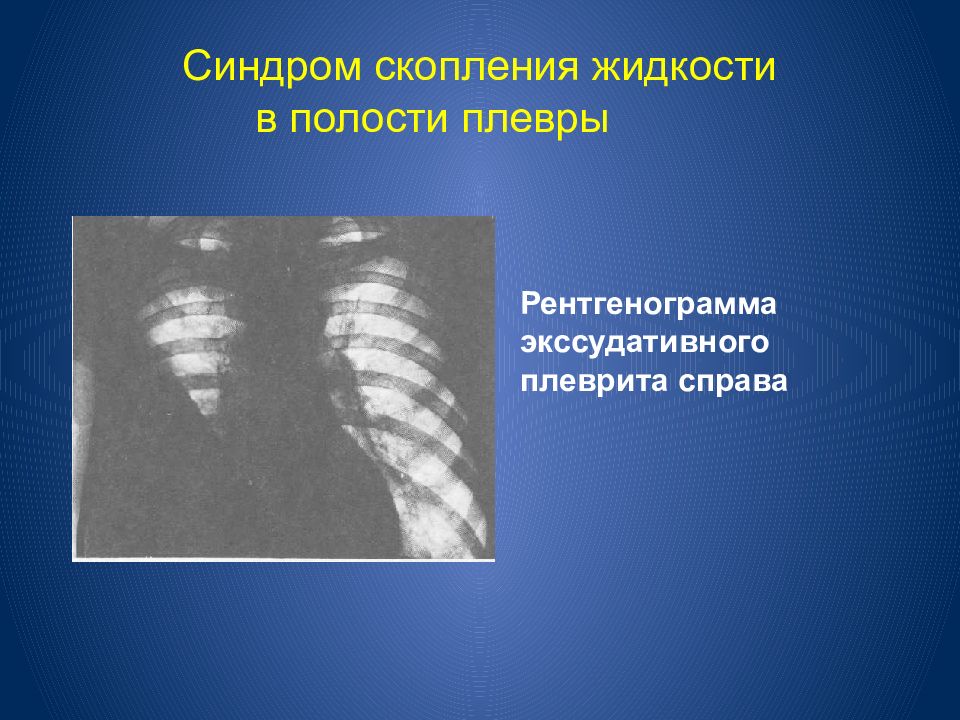 Наличие полости. Синдром скопления жидкости в плевральной полости рентген. Синдром скопления жидкости в полости плевры. Жидкость в плевральной полости рентгенограмма. Экссудативный плеврит рентгенограмма.