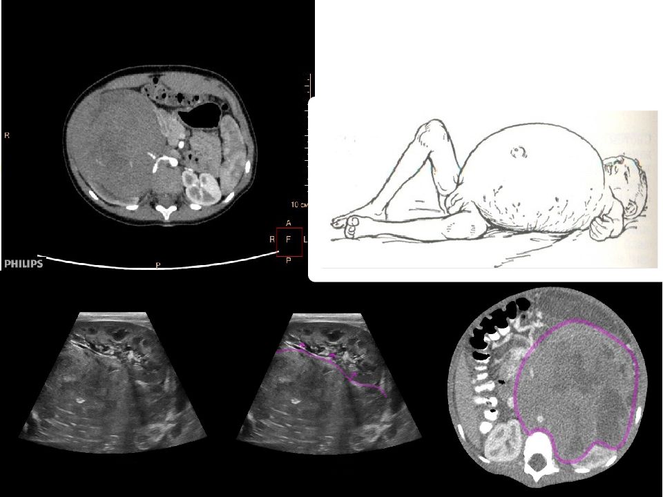 Нефробластома. Нефробластома (опухоль Вильмса). Эмбриональная нефробластома. Нефробластома метастазирование. Опухоль Вильсона нефробластома.