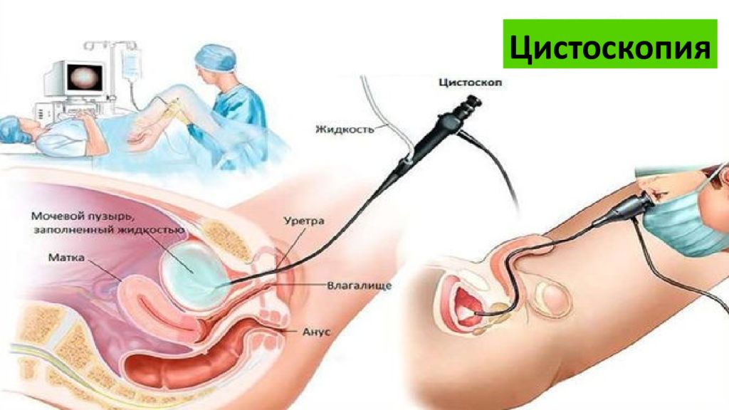 Цистоскопия это. Цистоскопия мочевого пузыря. Цистоскопия мочевого пузыря у женщин. Обследование цистоскопия.