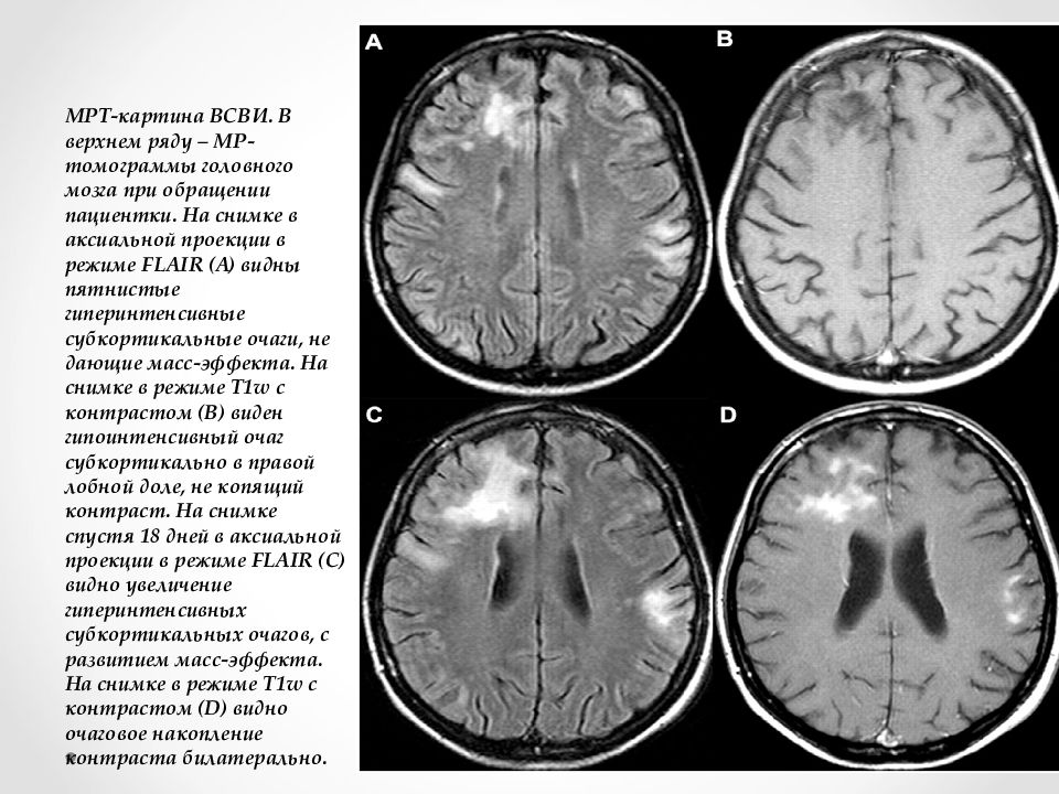Мр картина единичных супратенториальных очагов глиоза микроангиопатия