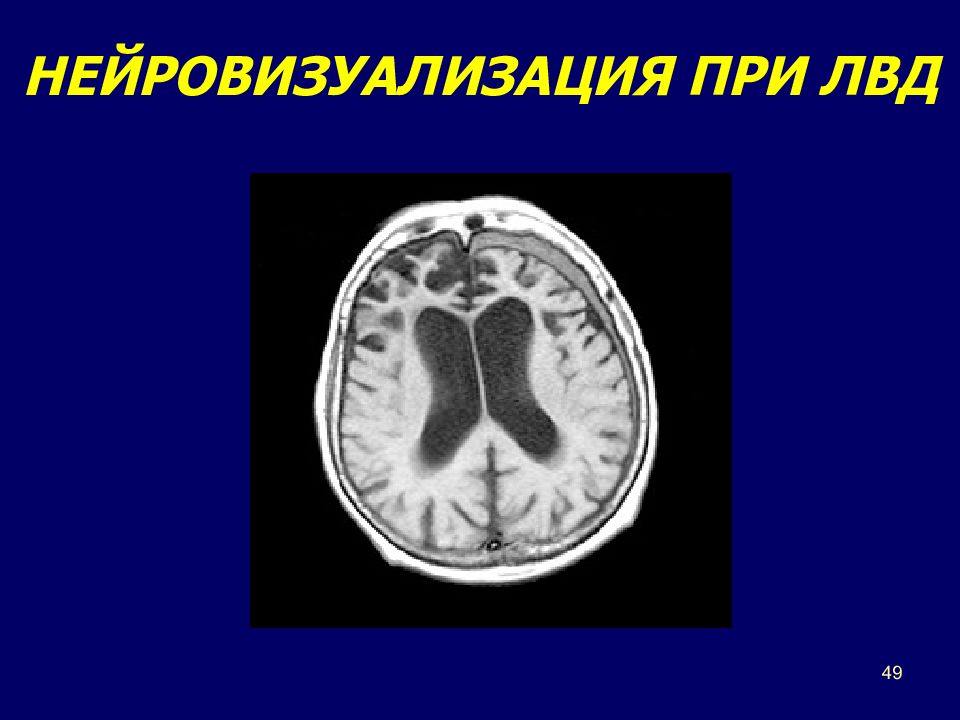 Височная деменция. Нейровизуализация при болезни Альцгеймера. Когнитивные нарушения мрт. Лобно-височная деменция мрт. Легкие когнитивные нарушения на мрт мозга.