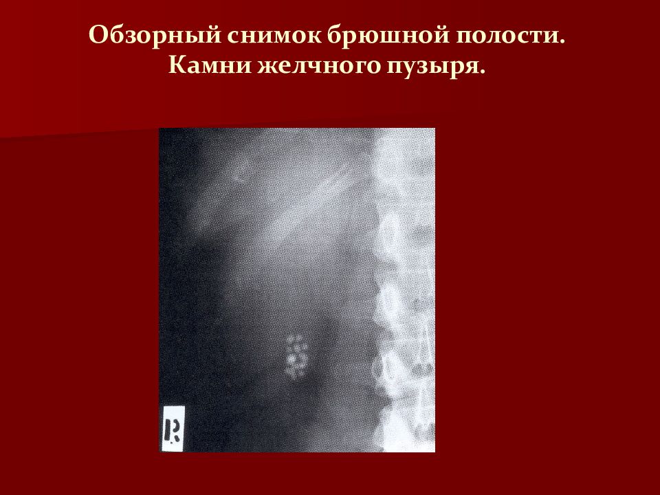 Снимок брюшной полости. Конкременты желчного пузыря лучевая диагностика. Конкременты в брюшной полости рентген. Киста желчного пузыря рентген. Желчный пузырь на рентгене брюшной полости.