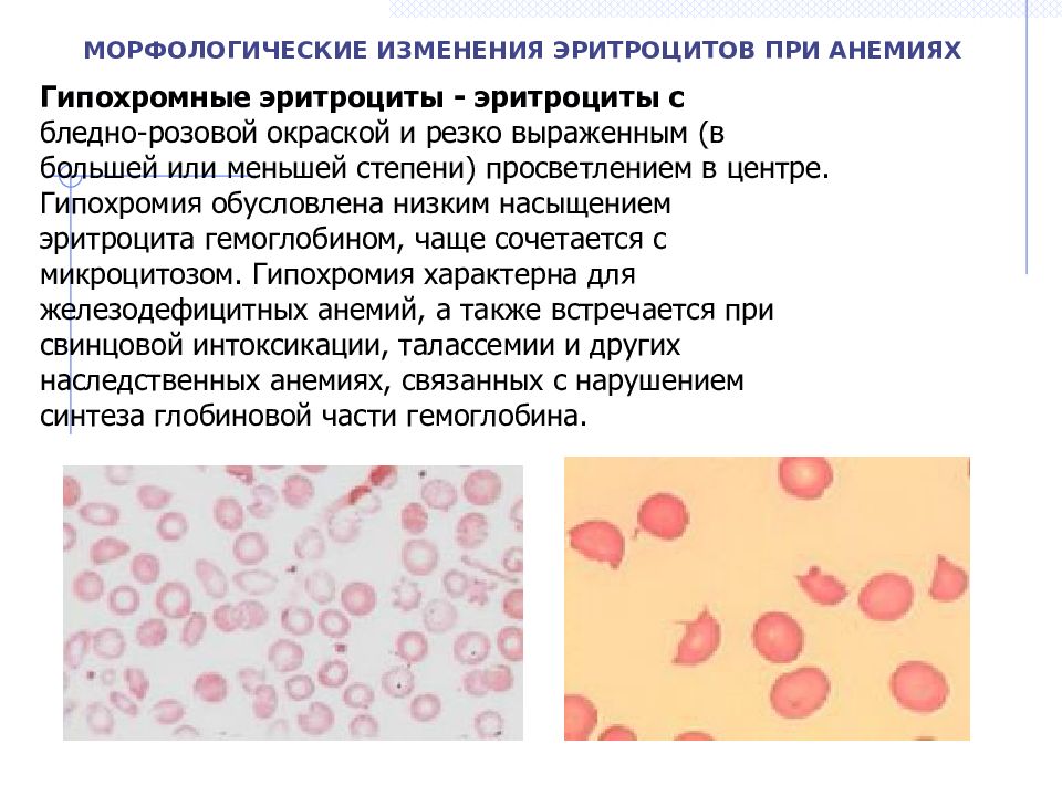 Измененные клетки. Гипохромия эритроцитов причины. Изменение морфологии эритроцитов при анемиях. Эритроциты при гипохромной анемии. Изменение окраски эритроцитов при анемии.