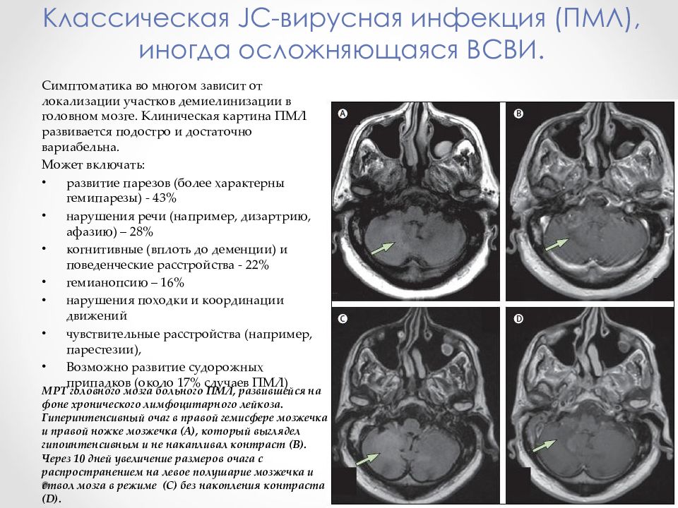 Лейкоэнцефалопатия кт картина