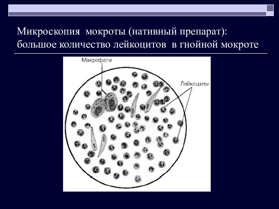 Исследование микроскопической картины мокроты