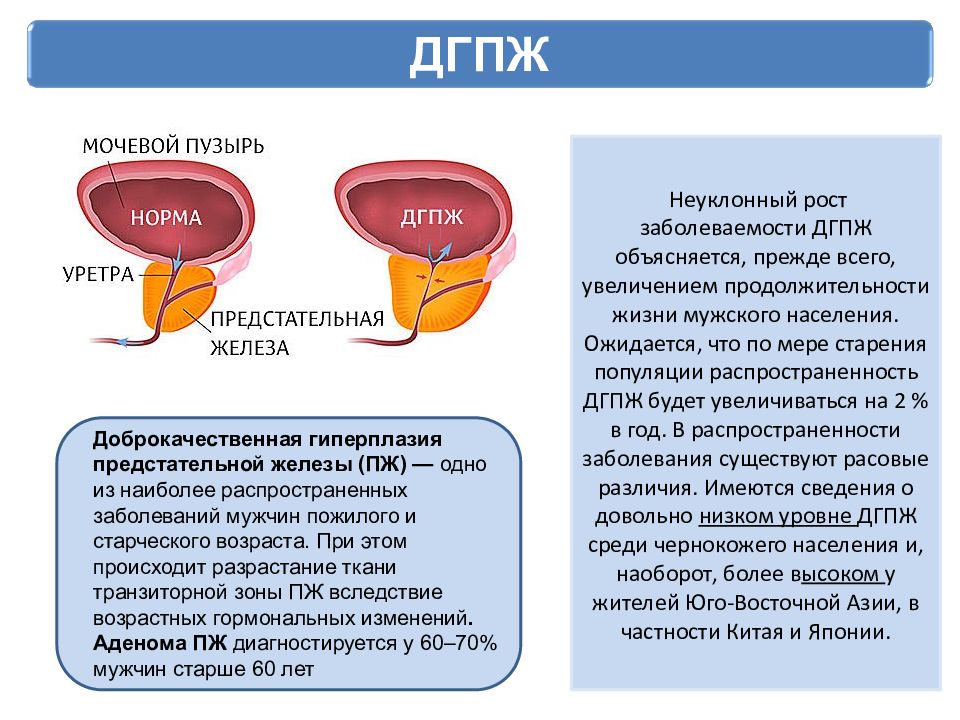 Мр картина гиперплазии предстательной железы