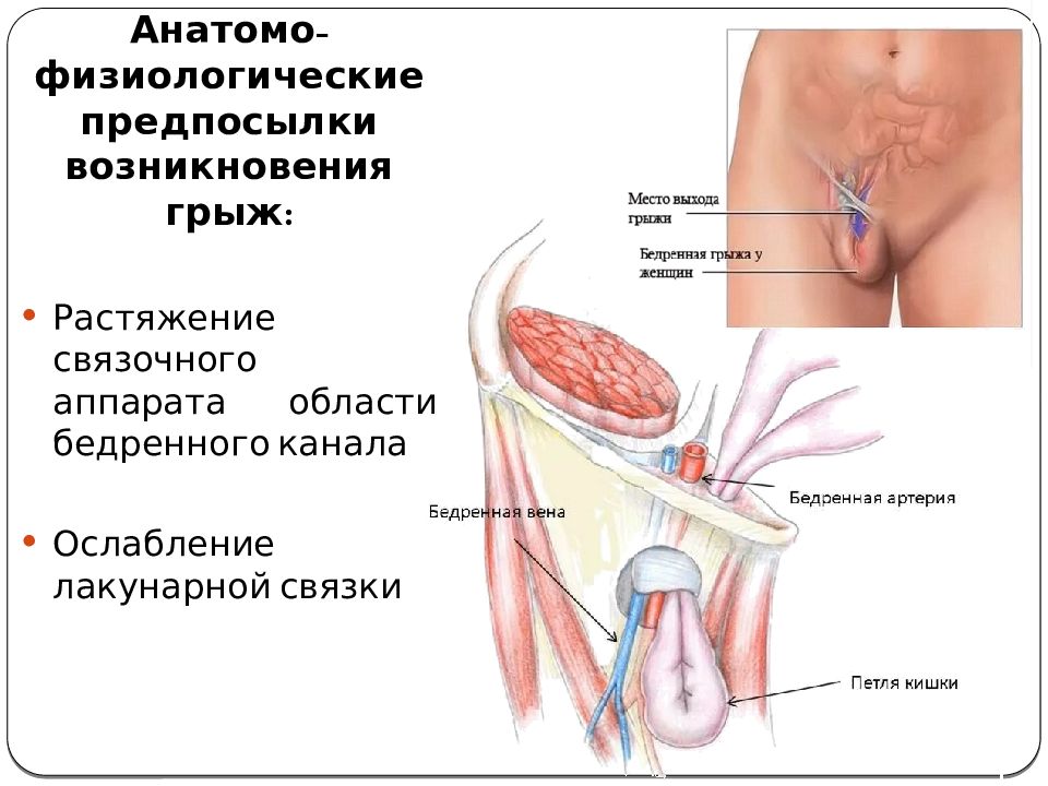 Бедренные грыжи топографическая анатомия презентация