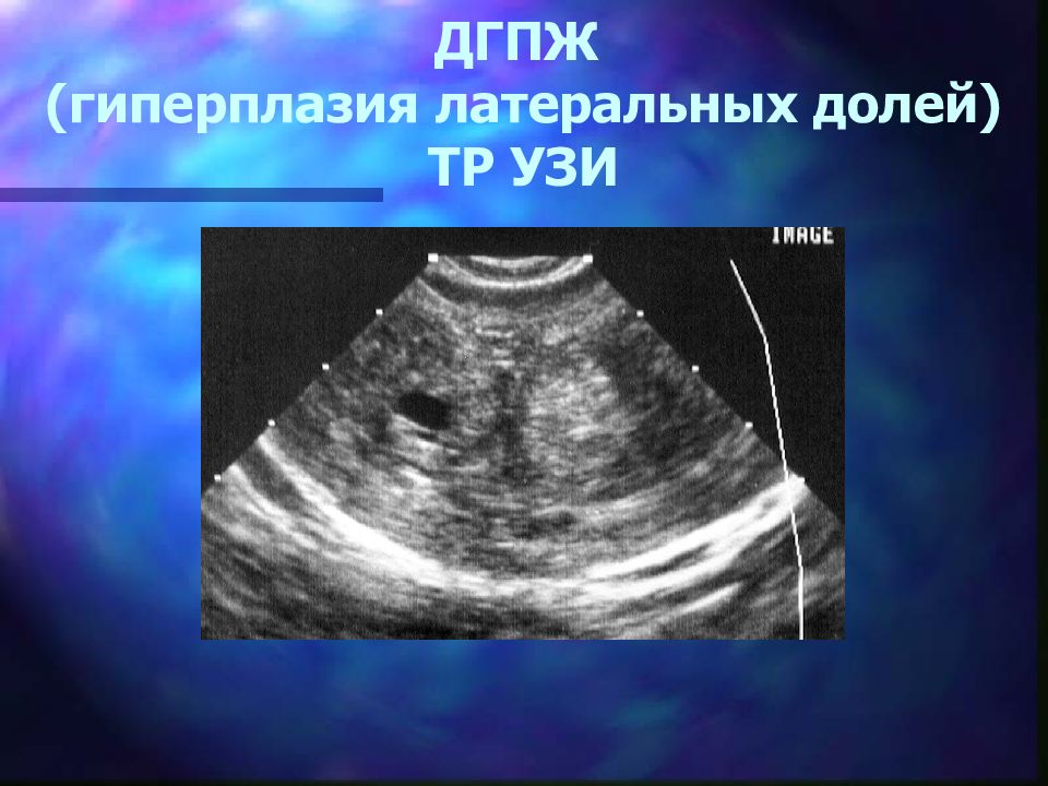 Гиперплазия предстательной железы 1. Гиперплазия предстательной железы УЗИ. Аденома предстательной железы на УЗИ.