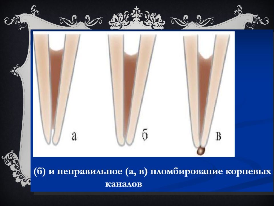 Пломбирование каналов презентация