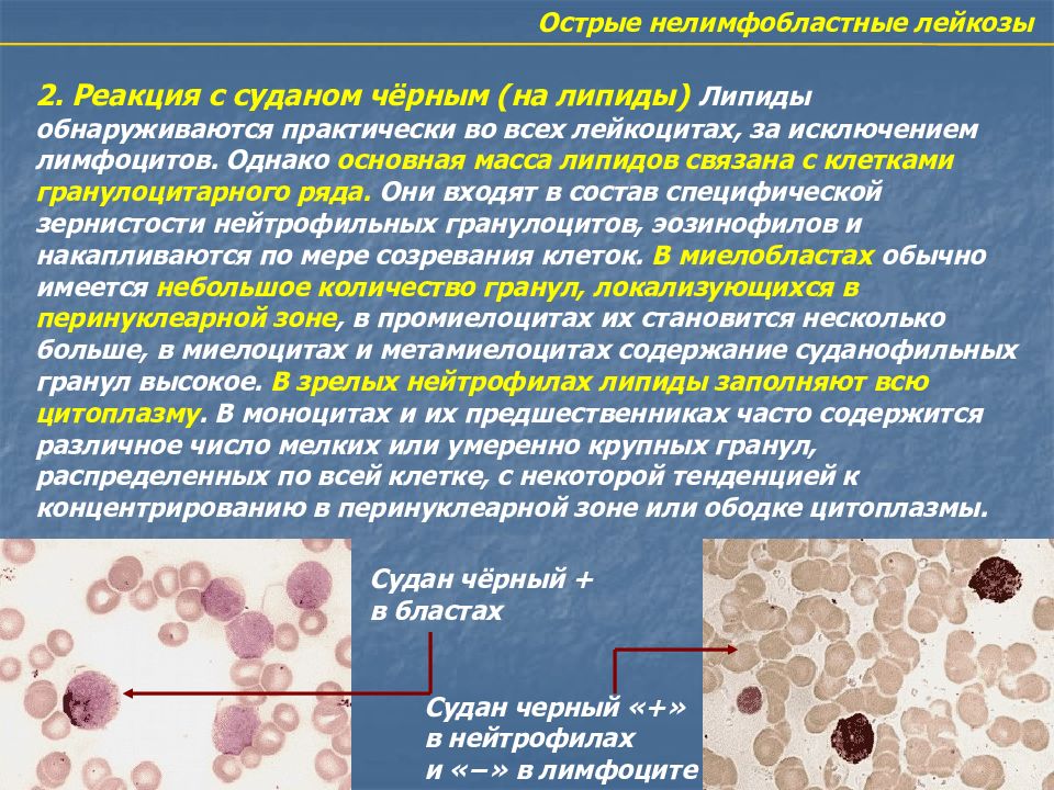 Период острого лейкоза. Острый лейкоз этиология патогенез. Острый лейкоз презентация. Острый лимфобластный лейкоз патогенез. Острый нейтрофильный лейкоз.