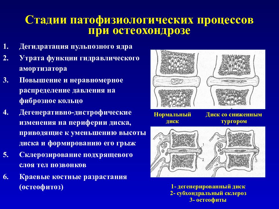 Дегидратации дисков что это. Дегидрация позвоночного диска. Дегидратация пульпозного ядра. Межпозвонковые диски дегидратированы что это. Дегидратация межпозвонковых дисков.