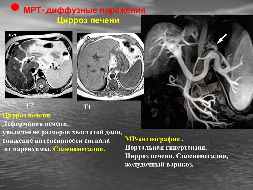 Диффузное усиление сосудистого рисунка печени у ребенка