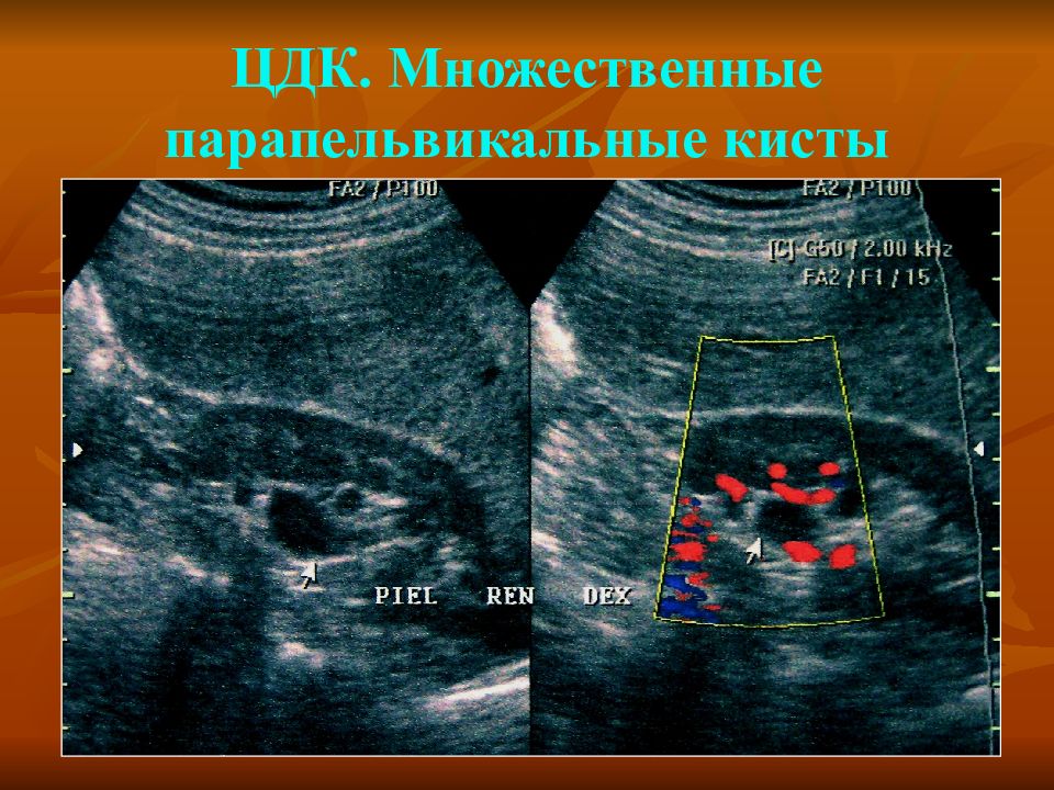 Парапельвикальные кисты почек