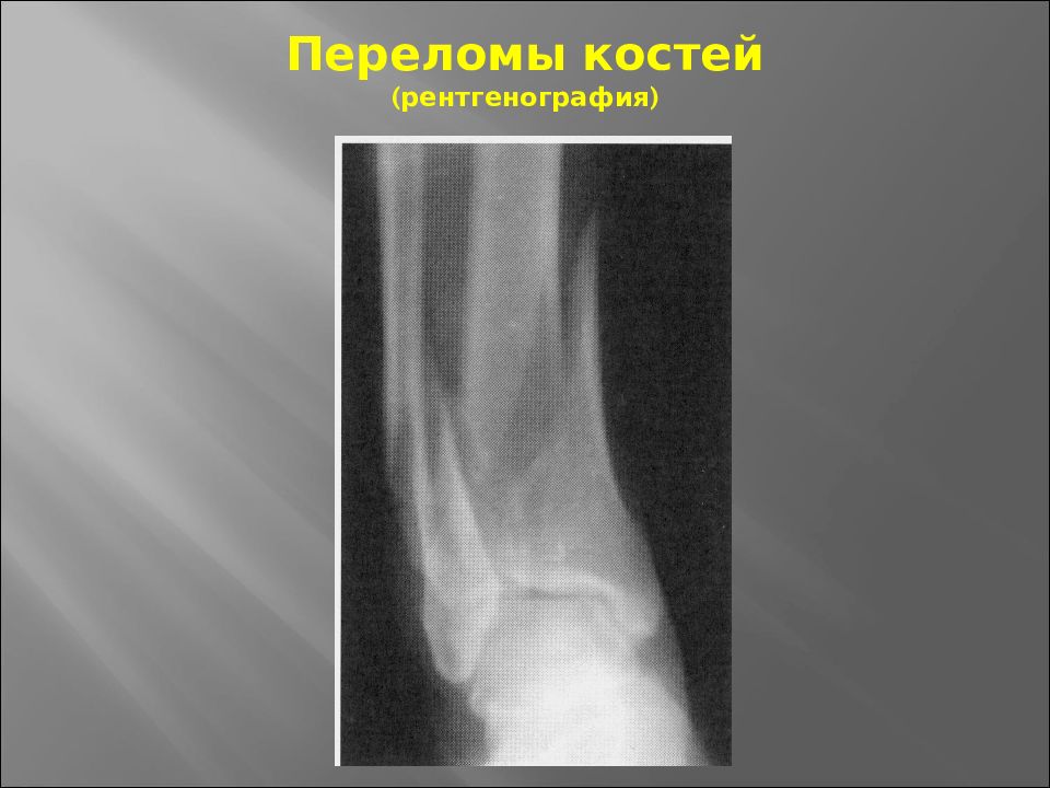 Переломы травматология презентация