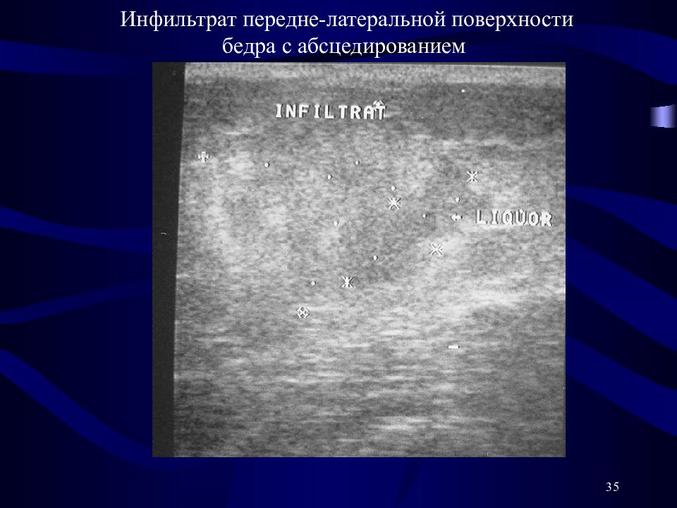 Узи тканей. Инфильтрация мягких тканей на УЗИ. Инфильтрат мягких тканей УЗИ картина. Инфильтрат мягких тканей на УЗИ протокол. Постинъекционный инфильтрат на УЗИ мягких тканей.