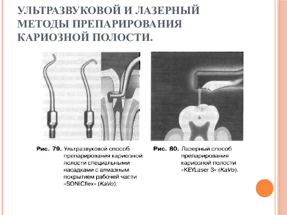 Размер кариозной полости