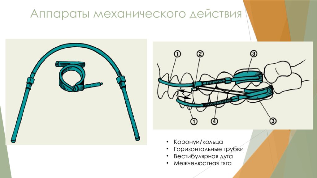 Горизонтальная трубка. Аппараты механического действия. Механические ортодонтические аппараты. Механические аппараты в ортодонтии. Ортодонтические съемные аппараты механического действия.