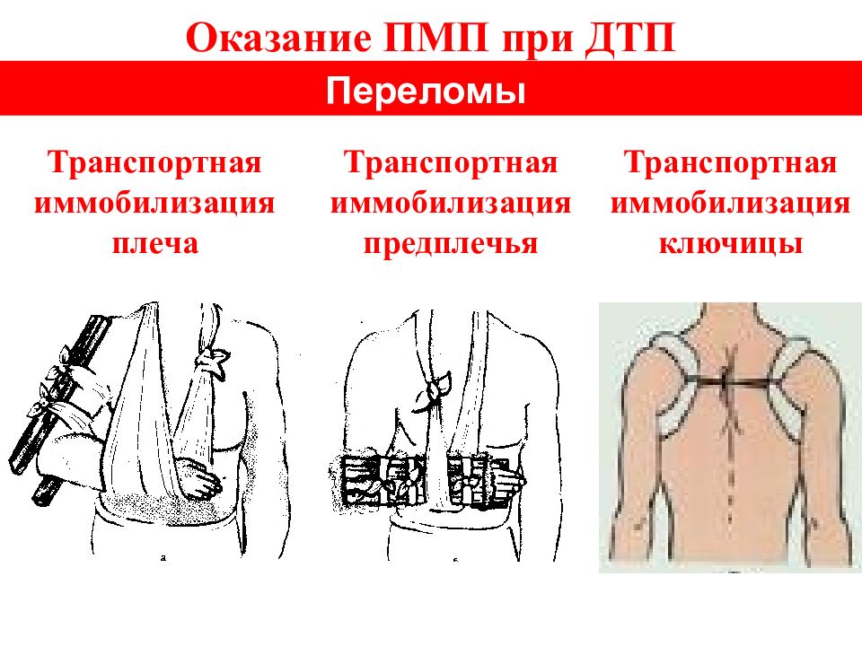 Помощь при переломе предплечья. Степень стеснения потока ПМП 91.