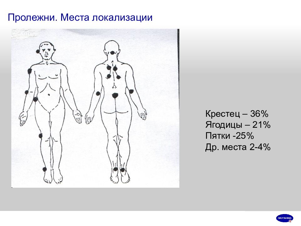 Места образования пролежней схема