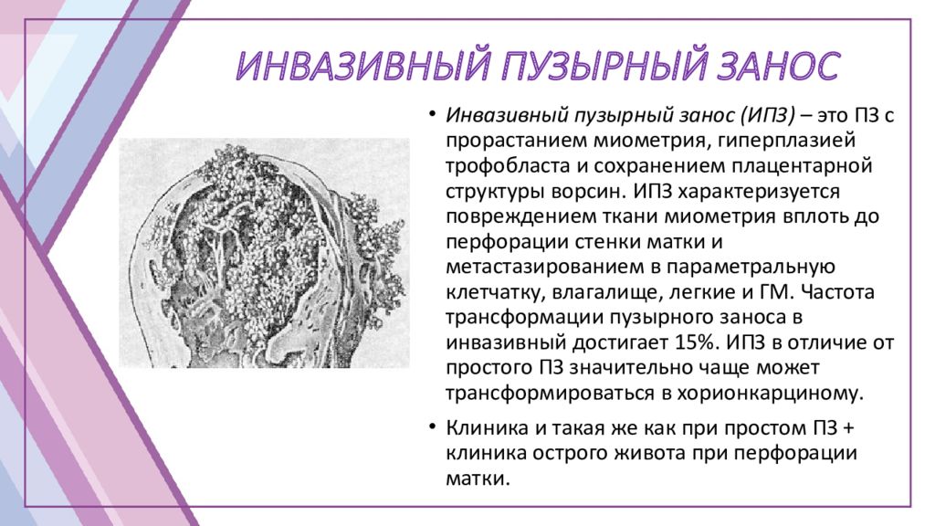 Пузырный занос. Пузырный занос презентация. Инвазивный пузырный занос. Пузырный занос клиника. Пузырный занос статистика мир.