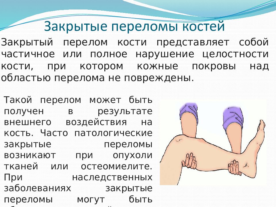 Перелом кости называется. Закрытый перелом костей. Переломы костей презентация. Закрытые переломы костей.