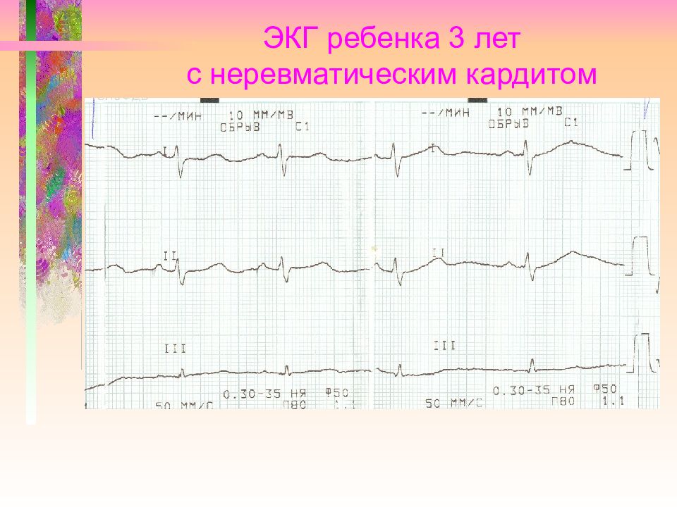 Неревматический кардит презентация