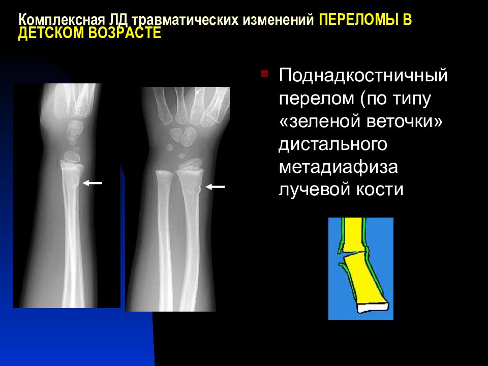 Перелом костей у детей. Поднадкостничный перелом по типу зеленой веточки. Надкостничный перелом лучевой кости. Переломы по типу “зеленой ветки”, поднадкостничные переломы.. Перелом поднадкостничный перелом лучевой кости.