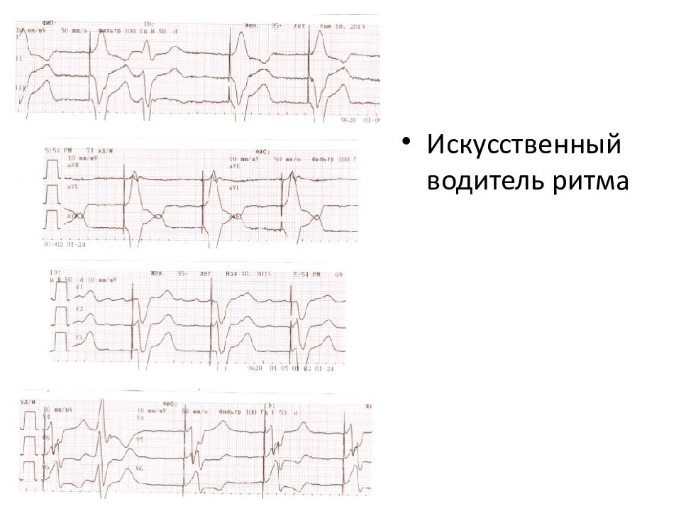 Экг диагностика. ЭКГ при искусственном водителе ритма. Искусственный водитель ритма. Искусственный водитель ритма сердца. Искусственный водитель ритма на ЭКГ.