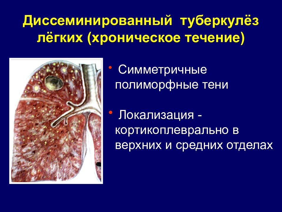 Диссеминированный туберкулез презентация