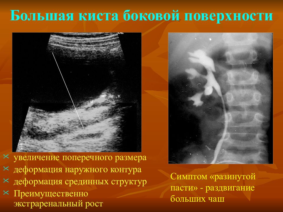 Увеличение поверхности. Экстраренальная киста. Экстраренальный рост кисты.