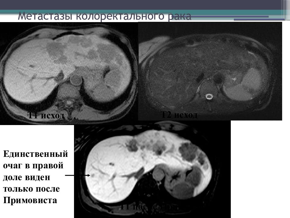 Единственными очагами. Метастазы колоректального. Метастазы печени Примовист. Примовист контрастное вещество для мрт.