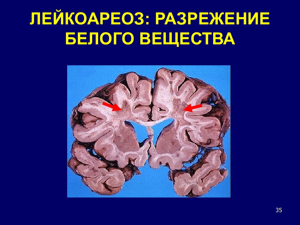 Лейкоареоз головного мозга симптомы. Лейкоареоз деменция. Лейкоареоза что это такое. Асимметричный лейкоареоз. Разрежение мозговой ткани это.