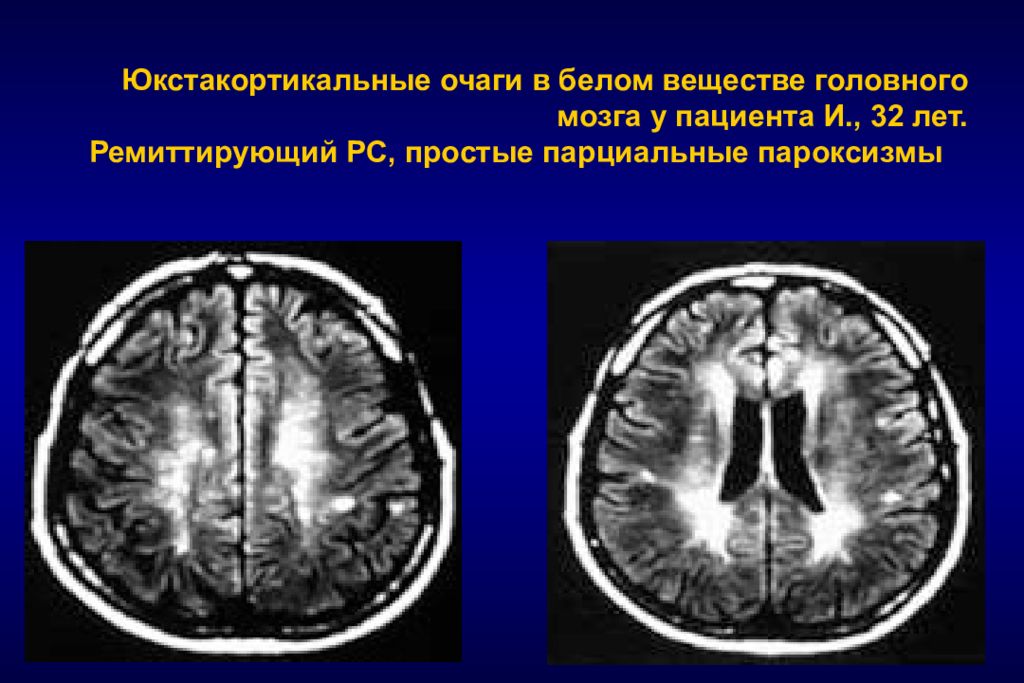 Единичный очаг в левой лобной доле. Инфратенториальные очаги головного мозга. Очаги в белом веществе головного мозга что это такое. Юкстакортикальные очаги головного мозга.